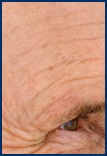 Man with forehead sunspots