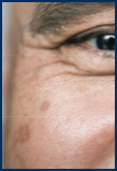 Man with sunspots on cheek