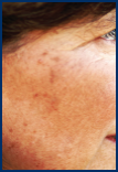 Actinic Keratoses on patient’s cheeks