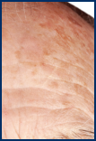 Actinic Keratoses on patient’s forehead